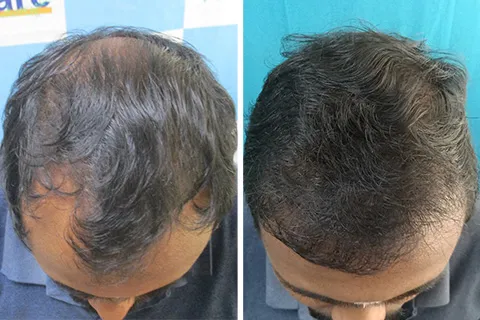 Hair rejuvation therapy before photo in VCare